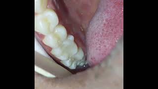 Root canal treatment  composite fillings in treating irreversible pulpitis severe toothache [upl. by Imarej]