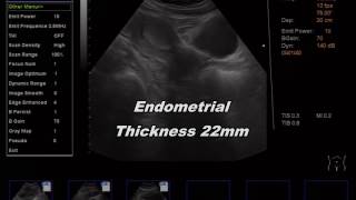 Endometrial thickness 22mm [upl. by Nwahser]