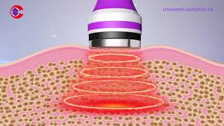 How Ultrasonic Cavitation Work How Ultrasonic Cavitation Remove Fat What Is Cavitation Machine [upl. by Syxela]