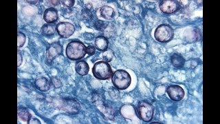 Histoplasmosis Systemic Mycoses 1 Microbiology MCQs [upl. by Leirua]