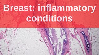 Breast Inflammatory Conditions  Pathology mini tutorial [upl. by Kotick]