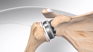 Reverse Total Shoulder Replacement with Univers Revers™ System [upl. by Eleik]