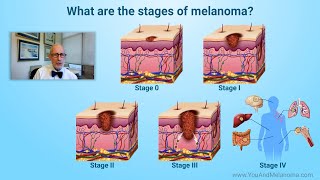 What are the stages of melanoma [upl. by Nolla90]