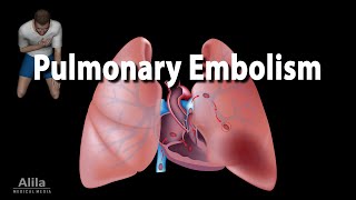 Pulmonary Embolism Animation [upl. by Hannahs35]