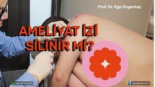 Ameliyat İzi Tedavisi [upl. by Tennos]