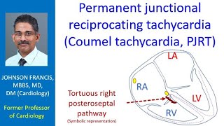 Permanent junctional reciprocating tachycardia Coumel tachycardia PJRT [upl. by Atteuqram]