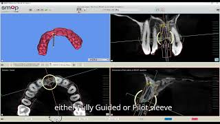 Unlock SMOP Mastery Essential Guide for Dentists  Hira Dental Lab Tutorial September 2024 [upl. by Eetnom845]