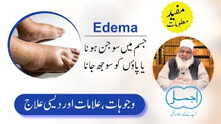 Edema Causes Symptoms and Treatment in Urdu  Swelling Feet  Oedema  Jism me Sojan ka ilaj [upl. by Inalial]