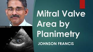 Mitral Valve Area by Planimetry on Echocardiogram [upl. by Elacsap189]