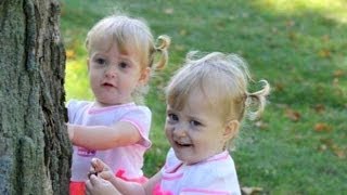 Conjoined Twins Learn to Live Apart [upl. by Mateya]