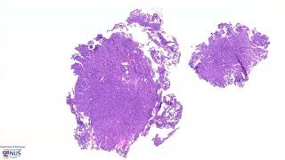 Pituitary gland Neuroendocrine tumour Pituitary adenoma Microscopy  Talking slide [upl. by Dewitt]