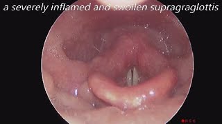 Acute Supraglottitis Due To Infection [upl. by Nyasuh288]