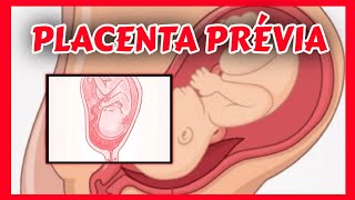 Comprendre le placenta previa [upl. by Hayimas314]