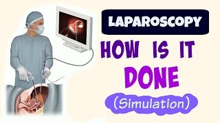 Laparoscopic Surgery How is it done simulation [upl. by Esinyl]