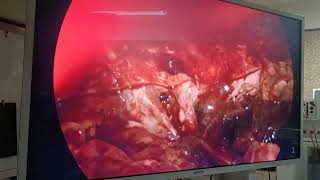 ruptured liver abscess with purulent peritonitis [upl. by Naujit]