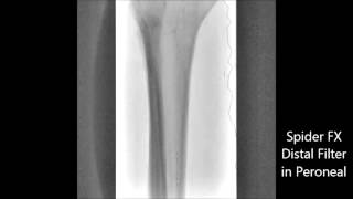 Peroneal Artery and Posterior Tibial PTA amp Atherectomy [upl. by Rici]