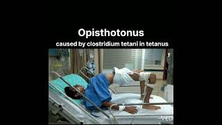 Opisthotonus caused by clostridium tetani in tetanusdoctorviral viralvideo ankylosingspondylitis [upl. by Lia]