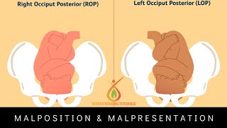 MalpositionOccipito Posterior Position  Hindi Explanation ritikasnursingtutorials [upl. by Jessen851]