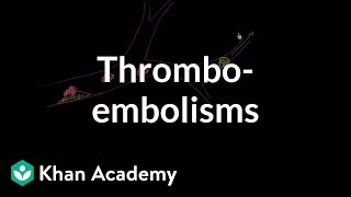 Thromboemboli and thromboembolisms  Miscellaneous  Heatlh amp Medicine  Khan Academy [upl. by Enelear222]