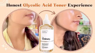 5 days Glycolic acid toner review on dry skin ✨ Fading Acne Marks amp Tanning [upl. by Yenruoj923]