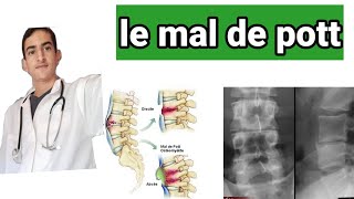 le mal de pott ou spondylodiscite tuberculeuse [upl. by Julietta]