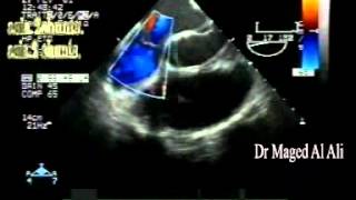 multiperforated atrial septal aneurysm [upl. by Winton]