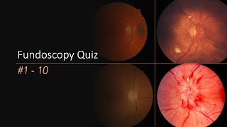 Fundoscopy Quiz [upl. by Akin242]