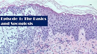 Episode1 A Survey of Dermatopathology The Basics and Spongiosis [upl. by Ymeon288]