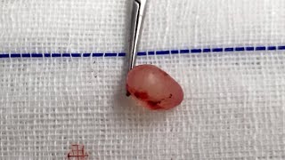 Epididymal Cyst [upl. by Anigroeg]