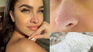 DIY BLACKHEAD REMOVER  How To Remove Blackheads At Home EASY Face Mask  Clears Skin [upl. by Annawat]