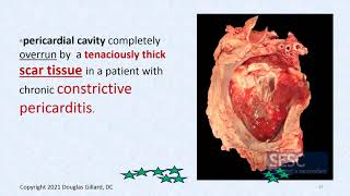 CVPP WK7 Thursday SPR 21Cardiac tamponade Kussmauls sign pulsus paradoxus and EKG PT 1 [upl. by Winny770]