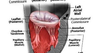 CASE PRESENTATION MITRAL VALVE PATHOLOGY [upl. by Beaner712]