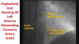 Angioplasty And Stenting Of Left Anterior Descending Coronary Artery [upl. by Onitsoga]