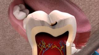 What is a Tooth Fissure [upl. by Vasileior]