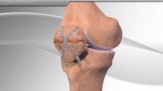 Patella Fracture Repair [upl. by Jenesia]