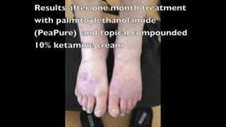 Palmitoylethanolamide and ketamine  Supplementary video 42417 [upl. by Sivad]