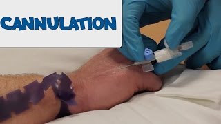 How to Perform Cannulation  OSCE Guide old version  UKMLA  CPSA [upl. by Piderit]