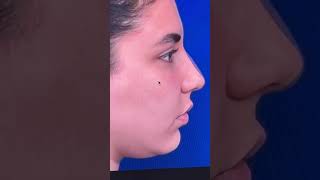 Paciente de rinoplastia antes de cirugía y después cirugiadenariz rhino [upl. by Elissa557]