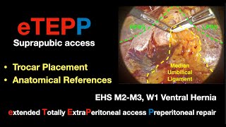 Preperitoneal eTEPP for M2M3 W1 R0 D2 Ventral hernia and Diastasis on female Dr Valenzuela [upl. by Aieki]