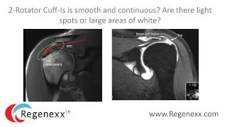 How to read your shoulder MRI with Dr Centeno of Regenexx [upl. by Ahsinoj693]