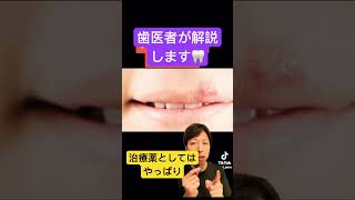 口内炎。何とかしたい🦷stomatitis 口内炎 応急処置 治療 早く治す 歯医者 薬 方法 歯科衛生士 歯科助手 豆知識 生理食塩水 [upl. by Donahoe]