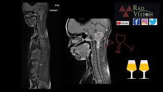 EPENDYMOMA WITH DROP METASTASIS [upl. by Notac52]