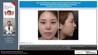 Use of Autologous AdiposeDerived Stromal Vascular Fractions in Revision Rhinoplasty for Severe [upl. by Droffilc]