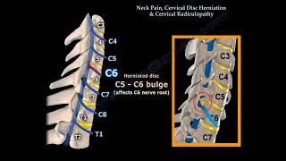 quotNeck Pain Cervical Disc Herniation and Radiculopathy Causes Symptoms and Treatmentquot [upl. by Aerdnaed169]