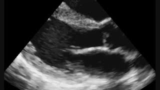 Colour Doppler Echocardiogram In Anterior Wall Myocardial Infarction AWMI [upl. by Akeihsat]