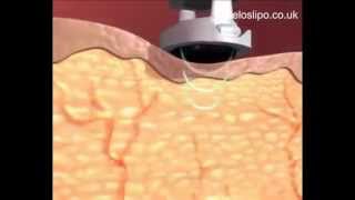 How Ultrasonic Cavitation Works [upl. by Hilleary392]