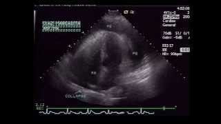 Pericardial Effusion with RA Collapse [upl. by Seif]