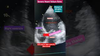 Pacemaker ICD Lead in Right Ventricle for weak Heart l पेसमेकर l echo heartfailure shorts [upl. by Nyrrat]