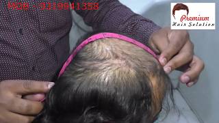 Hair Bonding in Chennai  9319941358  Hair Bonding Clinic in Chennai  PHS [upl. by Ecyle703]