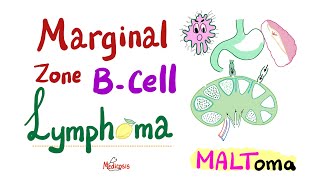 Marginal Zone BCell lymphoma MALToma  Indolent BCell NonHodgkin’s Lymphoma  Hematology Onco [upl. by Frasco]